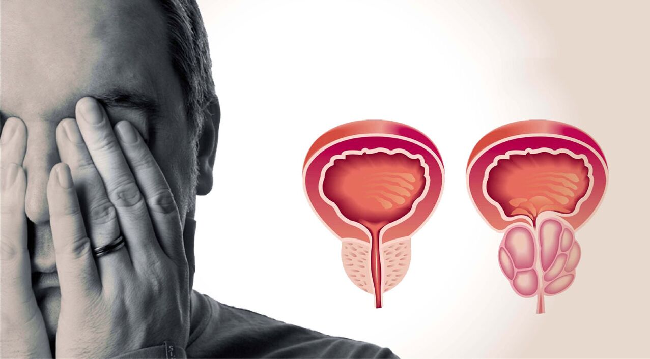 chronic prostatitis in men
