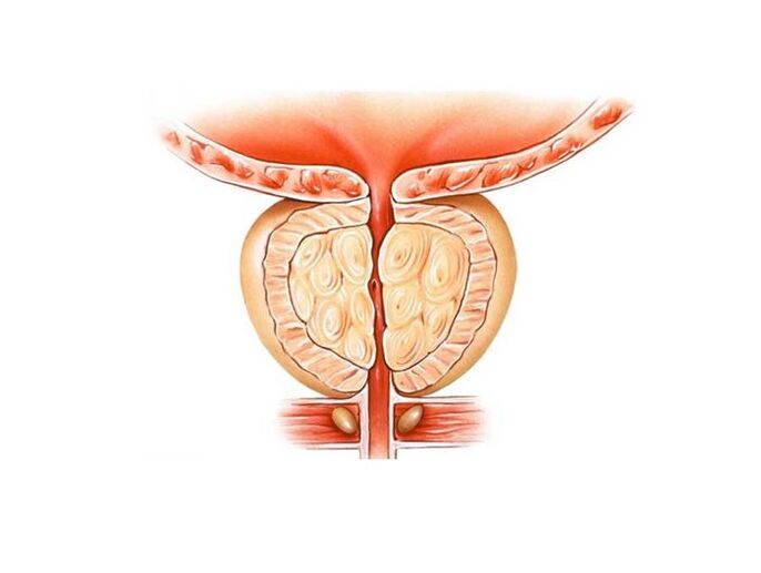 treatment of prostatitis with folk remedies